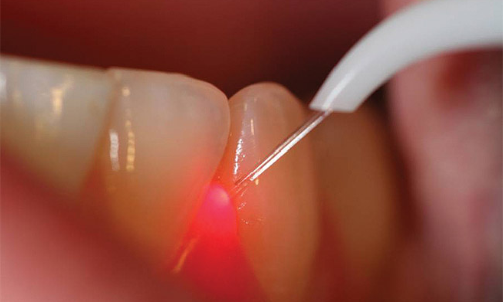 Laser in Odontoiatria